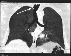 Reconstruction of the chest CT scan showing the diverticulum (indicated by the arrow).