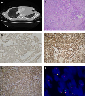 (A) CT scan showed a giant mass in the left superior mediastinum (arrow). (B) Microscopic findings revealed nests of small round cells with scattered squamous epithelial differentiation in the center (×50). (C–E) Pancytokeratin (×100), p63 (×100), NUT (×50) were diffusely positive. (F) The NUT probe detected the break-apart positivity by FISH.