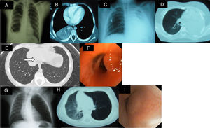 (A) Consolidation in right lung base and small ipsilateral pleural effusion. (B) Consolidation and atelectasis in RLL, associated with small right posterior pleural effusion. (C and D) Massive atelectasis of left lung. (E) Lesion in the interior of the basal segmental bronchus with a hyperdense punctiform image of polypoid appearance. (F) Fiberoptic bronchoscopy showing a reddish, pedunculated, well-defined mass. (G) Air trapping in left lung with slight tracheal shift. (H) Lung CT: stenosis of left main bronchus and left pulmonary hyperinflation. (I) Non-pulsatile mass in entrance of left main bronchus, obstructing 70%–80% of lumen with vascularization of mucous membrane.