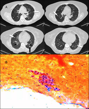 (A) Computed axial tomography slices in expiration, without the administration of intravenous contrast: multiple bilateral solid pulmonary nodules (white arrows), diffuse thickening of the bronchial walls (thin black arrows), associated with a mosaic attenuation pattern, suggestive of air trapping (asterisks). The nodule in the left lower lobe (thick black arrow) is the nodule that was aspirated. (B) Cytology of fine-needle aspiration-biopsy of one of the nodules, showing a group of finely granular cytoplasmic cells with slightly irregular nuclei and punctiform chromatin on a hematic background.