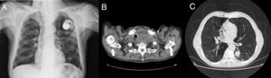 (A) Chest radiography showing right tracheal deviation. (B) Neck CT demonstrating right tracheal deviation due to thyroid enlargement. (C) Chest CT with multiple lung nodules.