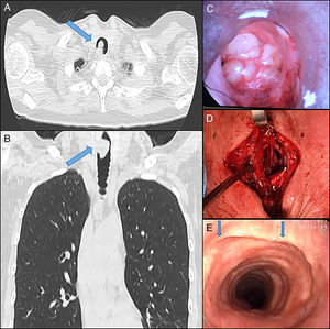 (A and B) Multislice computed tomography showing evidence of tracheal obstruction. (C) Endoscopic image prior to central airway relief by rigid bronchoscopy. (D) Tracheal oncologic resection with end-to-end anastomosis. (E) Postoperative bronchoscopic control. Blue arrow: suture line.