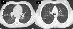 Lung CTs of 2 patients with a diagnosis of M. lentiflavum infection. Both patients revealed a clear tree-in-bud image (arrows) with acinar nodules (Δ), mainly in the right upper lobes.