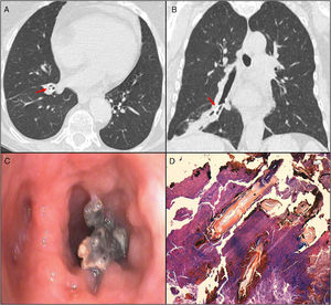 (A) Chest HRCT, axial slice: image of calcification in the righter lower lobe. (B) Chest HRCT, coronal slice. (C) Bronchoscopy image of foreign body. (D) Pathology image consistent with bone tissue.