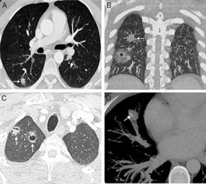 (A) Chest CT axial image (pulmonary parenchymal window) from 2013, showing a solid nodule in the right lower lobe (arrow). (B) Chest CT coronal image of the scan of the (pulmonary parenchymal window) from 2014, showing the appearance of 2 nodules in the right lung: one solid (arrow) and other subsolid with mainly ground glass attenuation and a small, solid core (asterisk). (C) Chest CT axial image (pulmonary parenchymal window) from 2016 showing the appearance of 2 cavitary lung nodules in the right pulmonary apex (arrows). Note that the most lateral nodule has non-centered cavitation with half-moon morphology. (D) Chest CT axial image (mediastinal window) from 2017 in which linear calcification (arrow) has appeared within a solid nodule in the middle lobe.