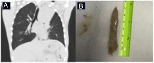 (A) Complete atelectasis of left upper lobe, containing a hyperdense cast of the bronchial tree. (B) Bronchial cast extracted by fiberoptic bronchoscopy measuring 7×1cm.