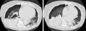 Transversal CT slices of the chest performed on day 23 of admission, showing right hydropneumotorax, right lower lobe atelectasis and areas of consolidation, some cavitary, mainly in the right lung base. Cavitary pulmonary nodules and ground-glass opacities adjacent to the area of consolidation can be seen in the left lower lobe.