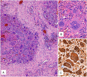 (A) Hematoxylin–eosin staining. Solid pattern cell proliferation with mononuclear cells and numerous osteoclast-like multinucleated giant cells. (B) Detail of the osteoclast-like giant cells with numerous nuclei, without atypia or significant mitotic activity. (C) CD68 immunostaining of both the mononuclear component and the osteoclast-like giant cells.
