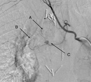 Pulmonary angiogram. (A) Bronchial suture. (B) Fissure suture. (C) Pseudoaneurysm of the first branch of the bronchial artery.
