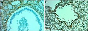 Terminal bronchiole with evidence of epithelial denudation. A • Hematoxylin and eosin (í10). Terminal bronchiole with an adjacent vessel in normal lung. Santa Clara Hospital Bogota Colombia. B • Fibronectin immunocytochemical staining (í40). Terminal bronchiole with evidence of denudation of the epithelium. Santa Clara Hospital Bogota Colombia. C • Collagen III Immunohistochemistry Staining (í10). Terminal bronchiole with evidence of denudation of the epithelium. Santa Clara Hospital Bogota Colombia.