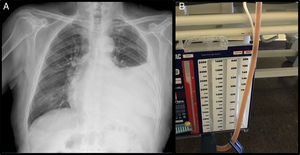 (A) Rifampicin-stained pleural fluid. (B) Chest X-ray showing a pleural effusion occupying the lower two thirds of the left hemithorax.