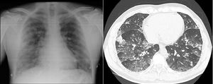 On the left, chest X-ray with bilateral reticular cotton–wool infiltrates. On the right, CT-angiogram (parenchymal window) showing alveolar and ground glass opacities in both lungs.