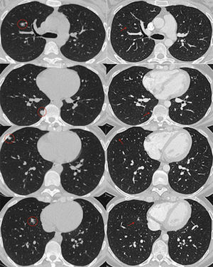 Chest CT. Pulmonary nodules at diagnosis and after 1 month of treatment. On the left, chest CT images showing lung nodules of varying size (circles) in the right middle and lower lobes and the paravertebral region. On the right, images showing complete resolution of some of the nodules (arrows) after one month of treatment, and others reduced in size.