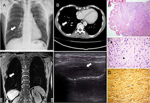 (A) Posteroanterior chest X-ray. (B) CT with intravenous contrast in mediastinum window. (C) MRI with GRE-T1 sequence after the administration of paramagnetic contrast medium. (D) Ultrasound with linear probe following an intercostal space. The white arrows show a lesion with extrapulmonary features in all images. In the ultrasound image, a linear image can be seen below the lesion corresponding to the pleuropulmonary line that, in the dynamic examination, showed normal movement suggesting no infiltration of the visceral layer. (E) Spindle-shaped cells in a whirling pattern, with trapped muscle and blood vessels. (F) Moderate cellular pleomorphism is observed, with occasional karyomegaly, alternating Antoni A hypercellular areas (+) and Antoni B hypocellular areas (*), with no visualization of mitotic figures. (G) Positivity for S100 protein.