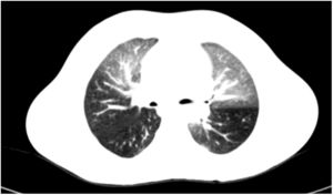 HRCT image in expiration showing areas of severe air trapping and multifocal, mosaic attenuation pattern.