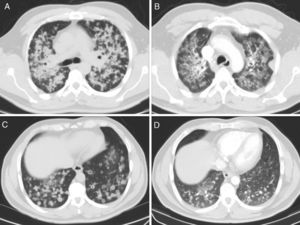 Computed axial tomography slices before (A and C) and 4 months after starting treatment (B and D).