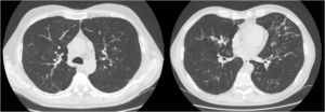 CT slices showing numerous areas of bronchiectasis in the pulmonary parenchyma.