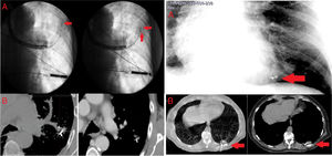 Left (case 1). (A) Fluoroscopy view of the introduction of the endobronchial brush catheter preloaded with the fiducial via the extendible working channel (left). Placement of second intratumoral fiducial (right). (B) Chest CT after endoscopic implantation, confirming presence of the intratumoral fiducial, with migration of the second. Right (case 2). (A) Low-radiation fluoroscopy view of 2 intratumoral fiducials during bronchoscopy. (B) Chest CT after endoscopic implantation, confirming presence of 2 intratumoral fiducials with no migration.