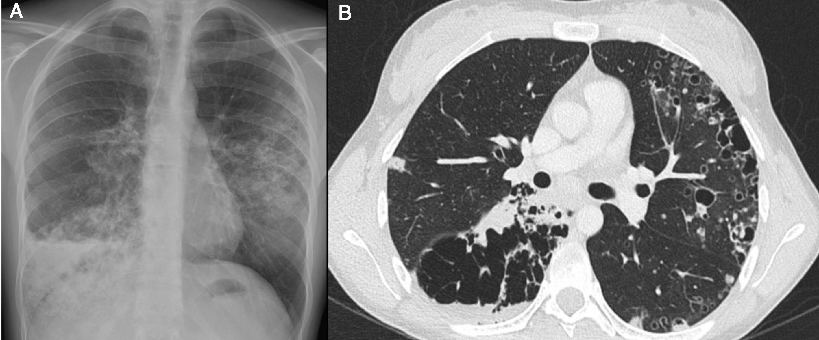 Cystic Adenocarcinoma of the Lung | Archivos de Bronconeumología