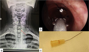 (a) Chest Rx showed a radiopaque needle foreign body. (b) Bronchoscopy showed a sharp metal object in upper airway and (c) 25 gauges needle removed after rigid bronchoscopy.