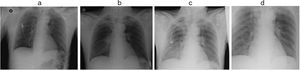 Progression on chest X-ray. (a) Day 1, after first extraction of sandy material with FB; (b) Day 3, perihilar and right basal infiltrate; (c) Day 5, right basal alveolar-interstitial infiltrate; (d) Day 6, bilateral alveolar-interstitial infiltrate not impinging on peripheral areas.