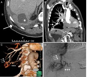 (A) Axial abdominal CT image showing a mass in the anterior mediastinum (asterisk). Note the presence of inflammatory changes in the right costophrenic sinus (arrow). (B) Maximum intensity projection (MIP) coronal reconstruction of the CT angiogram of the chest and upper abdomen showing a communication between a hypertrophic right inferior phrenic artery (black arrow) and a subsegmental pulmonary artery in the right lower lobe (white arrow). (C) Volume rendering of CT angiogram of the systemic-pulmonary fistula (short arrows indicate right inferior phrenic artery, while long arrows indicate the pulmonary artery). (D) Angiogram showing retrograde filling of pulmonary arteries (long arrows) from a tortuous, hypertrophic right inferior phrenic artery (short arrows).