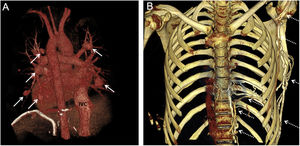 (A) Posterior view 3D volume rendering pulmonary CT angiography demonstrates multiple pulmonary artery aneurisms (arrows). (B) Anterior view 3D volume rendering CT angiography reveals enlarged collateral vessels in the left hemithorax wall and paravertebral areas (dashed arrows). Contrast media performed from left upper extremity reaches the inferior vena cava (IVC) and right atrium via these collateral vessels and the dilated left pherenic vein (dashed arrows). No contrast filling is observed in the SVC.