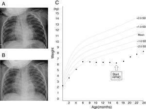 Chest X-ray images before the initiation of high-flow nasal cannula (A) and 1 month (B) after the initiation of high-flow nasal cannula. (C) Growth chart of the patient. Source: Ref. 5.