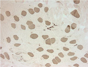 ATP-ase reaction at pH=4.3 – type I fibers are dark, type II fibers are light. The type I fibers are uniform in size and relatively normal in size while the type II fibers are small and atrophic.