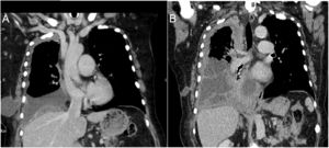 (A) A coronal CT image shows right sided-pleural effusion and ipsilateral fluid-containing cyst in the chest wall. (B) CT image shows partial resolution of the chest wall collection with increase in pleural thickening (particularly in the apex) as well as the pleural effusion. Note dense septations inside the fluid.
