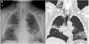 (A) Posteroanterior chest X-ray showing subcutaneous emphysema and persistent pulmonary consolidations in the RUL and LUL. (B) CT coronal reconstruction showing predominantly right-sided pneumomediastinum and subcutaneous emphysema in the cervical region.