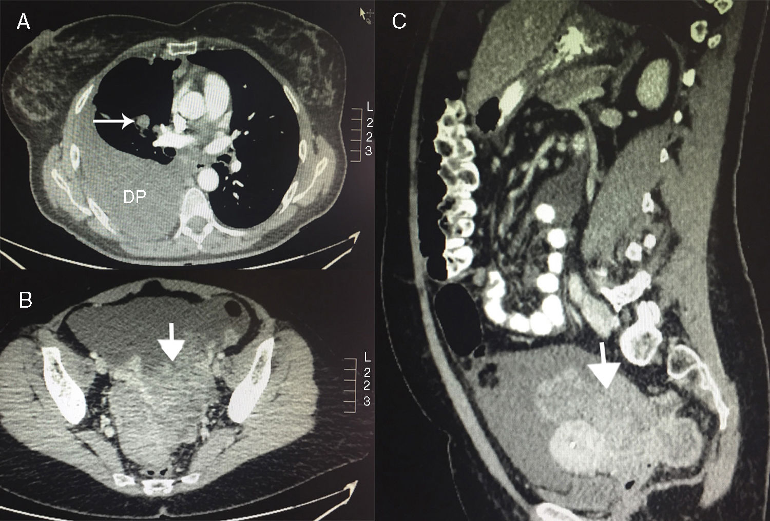 Krukenberg Tumor Secondary to Lung Adenocarcinoma | Archivos de ...
