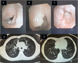 (A–C) Fiberoptic bronchoscopy image: pearly skin lesions in the posterior third of the vocal cords and vestibular folds of the glottis, extending to the trachea, causing 90% stenosis of the tracheal lumen. These lesions bleed easily. (D) Lung HRCT image: bilateral pulmonary ground glass pattern and a 6mm nodule in the posterior segment of the right upper lobe. (E) Lung HRCT: cylindrical bronchial dilation with slight thickening of bronchial walls.