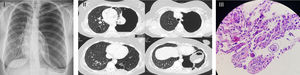 (I) Chest radiography at admission; (II) chest computed-tomography-scan; (III) histological examination.