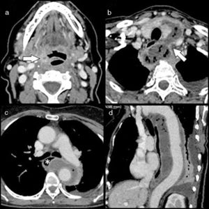 (a) Cervical CT in axial plane at the level of the epiglottis, showing an abscess measuring millimeters in the lower part of the right palatine tonsil (arrow); (b) cervical CT in axial plane at the level of the thyroid, revealing a collection with gas that surrounds the left thyroid lobe in an anterior direction, and then subsequently progresses in an posterior direction, passing into the chest through the upper left thoracic inlet (arrow); (c) chest CT in axial plane at the level of the carina: the collection is displayed in the middle and posterior mediastinum surrounding the thoracic aorta by more than 180°. This acts as a mass on the middle esophagus (asterisk); and (d) chest CT oblique sagittal plane, showing the collection extending along the entire length of the descending thoracic aorta. A small amount of pleural effusion can be observed.
