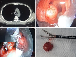 (A) Chest CT, showing the tracheal obstruction of the lumen by the tumor. (B and C) Images during resection of the tumor by rigid bronchoscopy, using Ligasure®. (D) Image of the surgical specimen and the Ligasure® blades.
