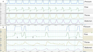 (A and B) Examples of normal and pathological patient-ventilator synchrony, determined with the help of thoracoabdominal belts. (A) The image shows perfect synchrony between the patient's thoracoabdominal movements and the ventilator cycles (continuous line). (B) The image of cycle 1 shows a long cycle, presumably due to leakage (the patient has finished exhaling while the ventilator continues in inspiration) and cycle 2 displays an ineffective respiratory effort (movement of belts without pressurization). Finally, in cycle 3, the beginning of the ventilator cycle is delayed with respect to the start of the movement of the belts (trigger delay, more apparent in the abdominal belt).