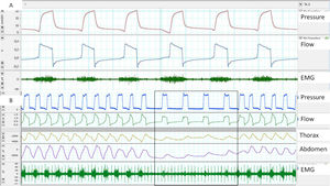 (A) Trigger delay, measured using parasternal EMG; note the delay between the start of muscle activation and the start of the ventilator cycle. (B) Lack of respiratory effort measured by parasternal EMG at the start of the controlled cycles provided by the ventilator, although it should be noted that the bands show a shift.