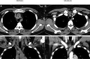 (A and B) CT scan with and without contrast, axial slices at rest and during Valsalva maneuver. (A) At rest, right paratracheal cystic lesion (*) located posterior to the trunk of the innominate veins (v) and posterolateral to the arterial brachiocephalic trunk (a). (B) In the Valsalva maneuver, the cystic lesion (*) rises through the fat of the upper mediastinum to the suprasternal cervical region, to a site anterior to the trunk of the innominate veins (v) and the arterial brachiocephalic trunk (a). (C and D) CT coronal reconstruction at rest (C) and during Valsalva maneuver (D). It can be seen that during the Valsalva maneuver, the cyst (*) rises approximately 3cm from the mediastinum to the site in the cervical region.