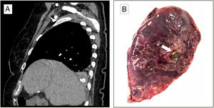(A) Sagittal image of the CT scan that shows foreign body with calcium density located in the right lower lung. (B) Image of the pulmonary resection showing the gallstone (arrow).