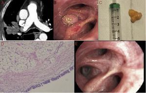(A) Lesion of fat density in the chest CT scan in the anterior segmental bronchus of the right upper lobe. (B) Examination with flexible fiberoptic bronchoscopy, showing the lesion occupying the entrance to anterior segmental bronchus of the right upper lobe. (C) Image of the lesion after excision. (D) Histologic image of the lesion (×10). (E) Image of recanalization of anterior segmental bronchus of the right upper lobe after treatment.