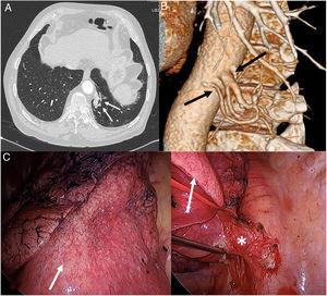 (A) Axial image of chest CT (pulmonary parenchymal window) showing a paramediastinal lesion in the basal segment of the left lower lobe (arrows). (B) Volumetric reconstruction of chest CT revealing the presence of 2 systemic arteries (arrows) that originate in the descending thoracic aorta and irrigate the pulmonary lesion, thus confirming the diagnosis of pulmonary sequestration. (C) Intraoperative image of: (1) pulmonary sequestration (white arrow) and (2) arterial vascularization (asterisk) of the pulmonary sequestration (white arrow).