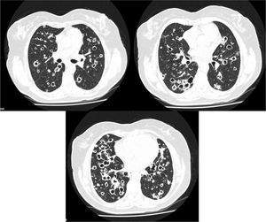 Thoracic CT scan of a 62 year-old women with stage IV lung adenocarcinoma, showing multiple bilateral thin-walled air-filled cavities with a diffuse distribution.
