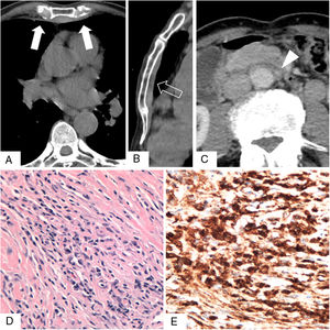 Unenhanced chest computed tomography scans obtained in the axial plane (A) and with sagittal reformatting (B), showing a flat, uncalcified anterior pleural plaque “bridging” the hemithoraces (arrows in A, open arrow in B). (C) Axial contrast-enhanced abdominal scan showing the periaortic soft tissue mass (arrowhead). (D) Photomicrograph of the pleural plaque showing storiform fibrosis and lymphoplasmacytic infiltrate (hematoxylin-eosin stain). (E) Immunohistochemical staining showing immunoglobulin G4 positivity in plasma cells.