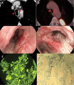 (A and B) Computed tomography and PET. (C and D) Raised erythematous hypervascular plaques in the right middle third of the trachea and main carina extending along the medial wall of the right main bronchus. (E and F) Presence of acidophilic deposits in the submucosa corresponding to amyloid substance after specific staining with Congo red and thioflavin T.