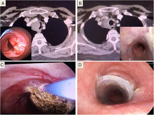 (A) Bronchoscopy and CT image of tracheal stenosis. (B) Outcome after treatment with corticosteroids and stenting, after 4 months. (C) Argon plasma coagulation, after biopsy. (D) Placement of Dumon® stent.