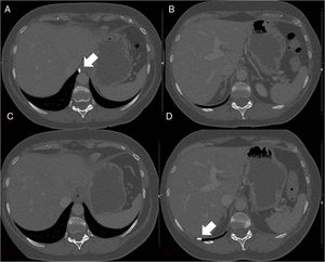 (A and B) Chest CT bone window images showing the right calcified pleural nodule adjacent to the esophageal hiatus. (C and D) Chest CT bone window images obtained subsequently to images A and B, in which the calcified pleural nodule has migrated to the posterior costophrenic recess.