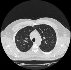 Chest CT. Diffuse micronodular pattern in both lung fields.