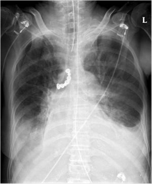 Anterior–posterior chest X-ray demonstrating the radiopaque 7-unit dental prosthesis (arrow) in the patient