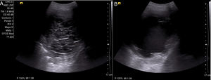 Patient, 61 years of age, with malignant pleural effusion due to stage IV kidney cancer, presenting with non-draining tunneled catheter. Chest ultrasound showing abundant septa preventing drainage of pleural fluid (A). A single dose of 100000IU urokinase was instilled and left to act for 2h; the thoracic ultrasound was then repeated, revealing pleural effusion containing detritus and lysis of the septa (B). The effusion was than drained, obtaining 750ml of serosanguineous pleural fluid and subsequent symptomatic improvement.